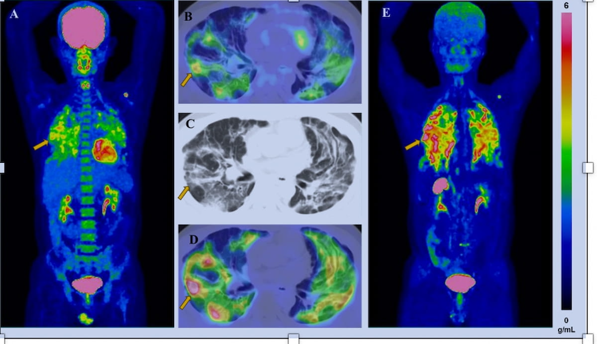 SNMMI: Study Shows Viability of FAPI PET/CT in Predicting Progressive Pulmonary Fibrosis in Lung Disease Patients