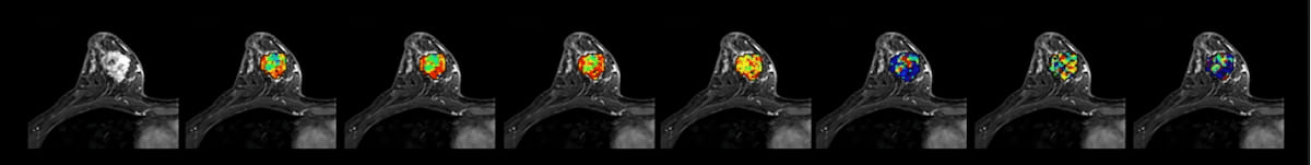 Can Diffusion MRI Predict Patient Response to Neoadjuvant Chemotherapy for Breast Cancer?