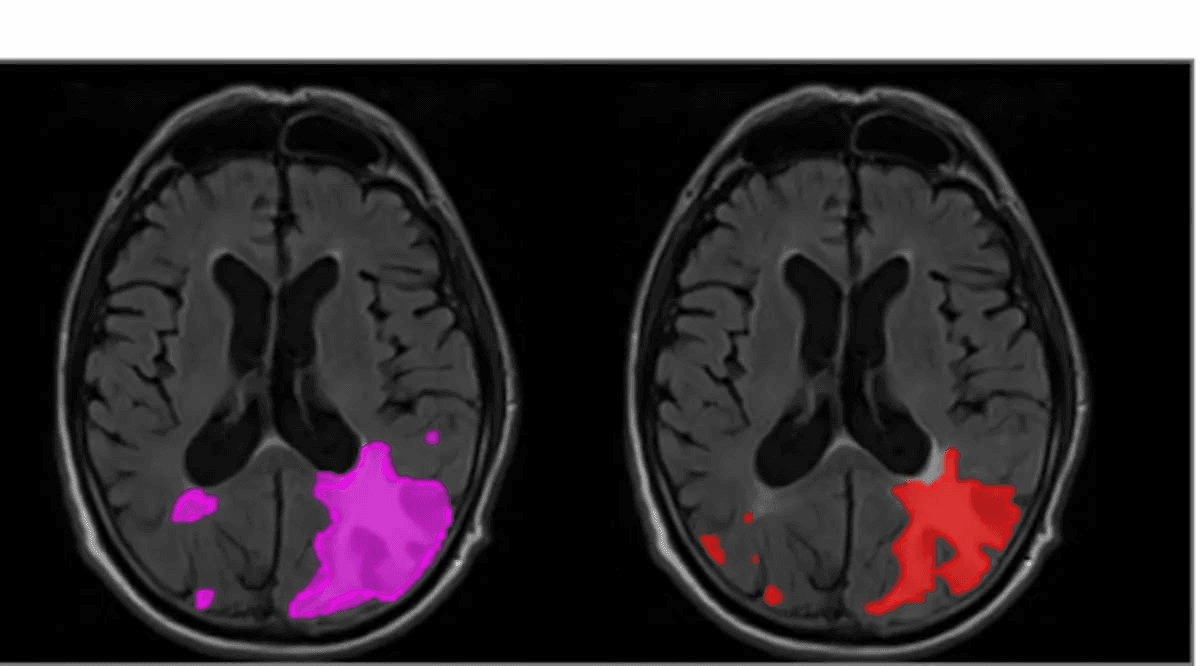 FDA Clears AI-Powered MRI Software for ARIA Detection in Patients with Alzheimer’s Disease