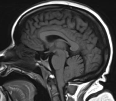 Image IQ: 52 y/o with Vertigo, Headache, Tinnitus