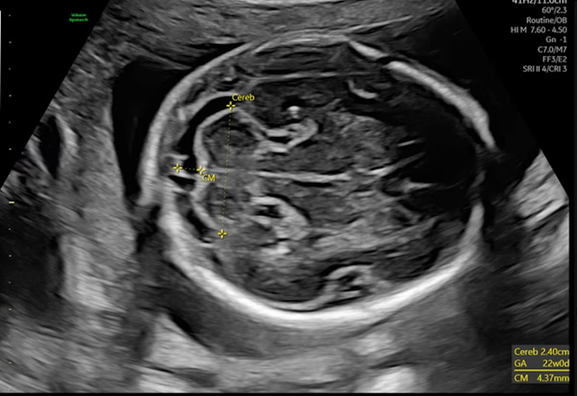 New AI-Powered Ultrasound Devices Enhance Efficiency in Women’s Health Imaging